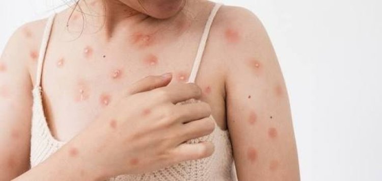Dinkes Meranti Tegaskan Tidak Ada Penambahan Kasus Cacar Monyet